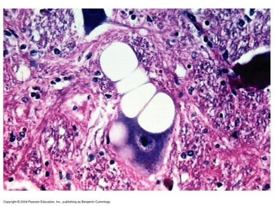 Neural tissue with prion-induced vacuoles and plaques