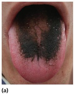 Adverse effect: black hairy tongue