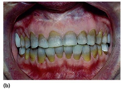 Adverse effect: tooth discoloration