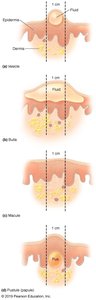 Diagram of skin lesion types: vesicle, bulla, macule, pustule