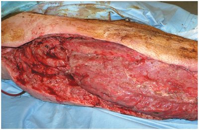 Necrotizing fasciitis with extensive tissue destruction