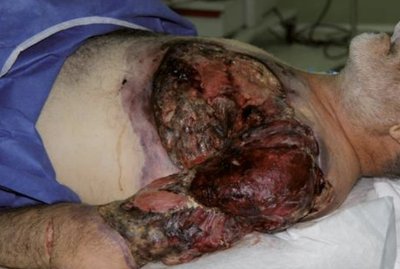 Necrotizing fasciitis with severe tissue necrosis