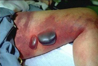 Gas gangrene with tissue swelling and necrosis