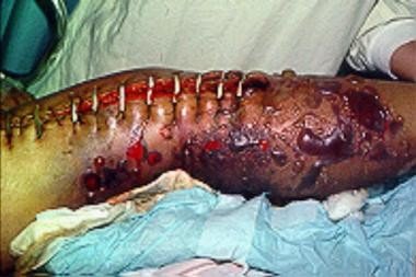 Severe gas gangrene with tissue destruction