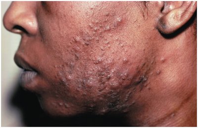 Nodular cystic acne with scarring
