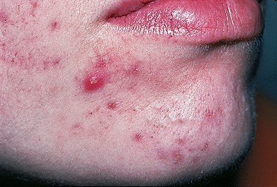 Comedonal and inflammatory acne on the face