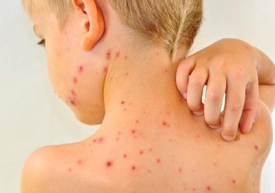 Chickenpox rash on a child's back