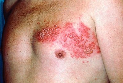 Shingles rash on the chest, following a nerve