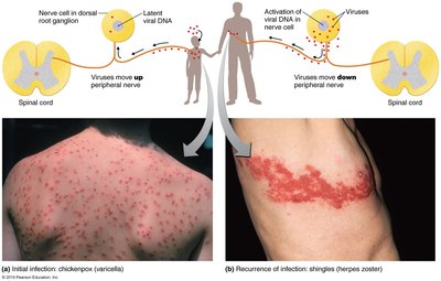 Diagram of varicella-zoster virus reactivation and clinical presentation