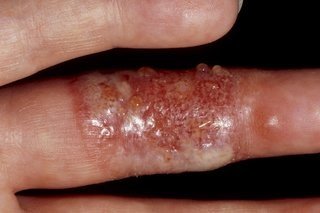 Herpetic whitlow on the finger