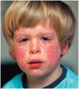 Measles rash on the face of a child