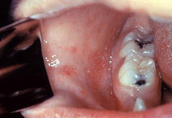 Koplik spots on the oral mucosa, diagnostic for measles