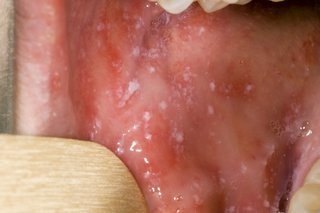Close-up of Koplik spots on the oral mucosa