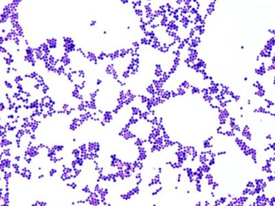 Gram stain of Staphylococcus showing clusters of cocci