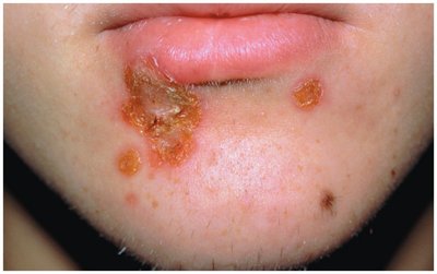 Impetigo lesions on the face