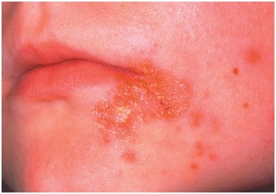 Impetigo lesions on the face