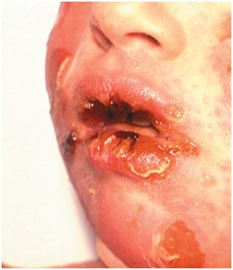 Scalded skin syndrome affecting the face