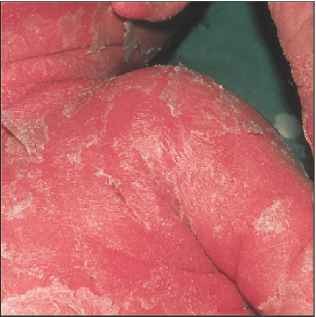 Scalded skin syndrome with widespread skin peeling