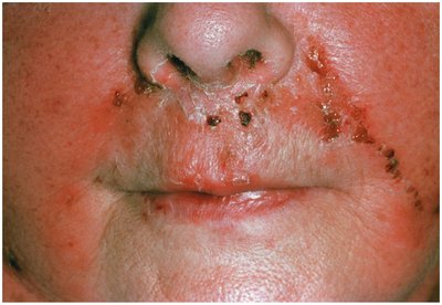 Erysipelas with red, raised patches on the face
