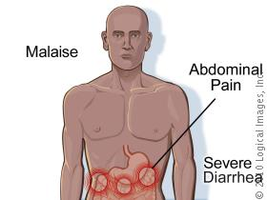 Symptoms of Giardia infection: malaise, abdominal pain, severe diarrhea