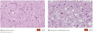 Normal and spongiform encephalopathy brain tissue