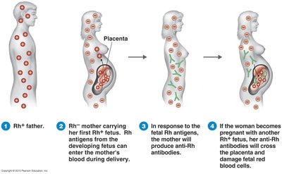Rh incompatibility and hemolytic disease of the newborn