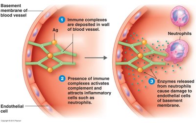 Immune complex deposition and tissue damage in Type III hypersensitivity