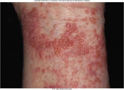 Contact dermatitis (Type IV hypersensitivity) on the skin