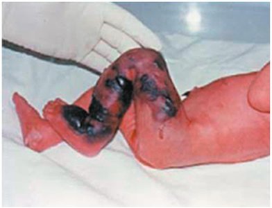 Necrotizing fasciitis in a newborn