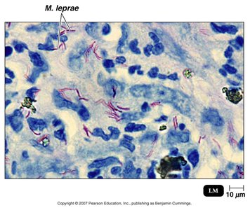 Acid-fast stained Mycobacterium leprae