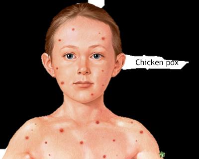 Pathogen in bloodstream (viremia)