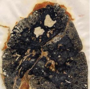 Anthracosis (coal worker's lung)