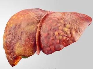 Cirrhotic liver, a complication of haemochromatosis