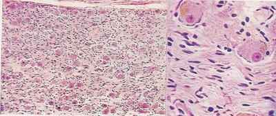 Lipofuscin pigment in ganglion cells