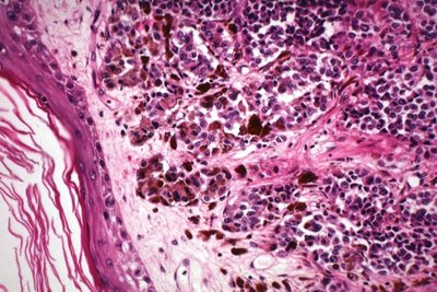 Melanin-laden macrophages in melanoma