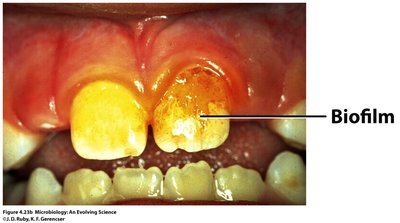 Biofilm on teeth