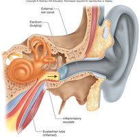 Otitis media: anatomy and pathogenesis