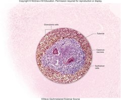 Tubercle formation in tuberculosis