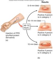 Tuberculin skin test for tuberculosis