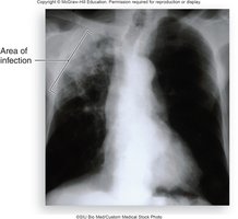 Chest X-ray showing area of infection in tuberculosis