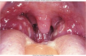 Pharyngitis symptoms: inflamed throat with white packets