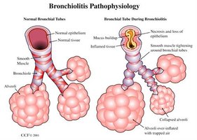 Bronchiolitis pathophysiology: normal vs. inflamed bronchioles