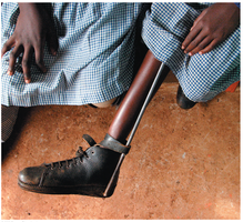 Polio can result in severe paralysis