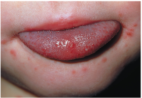 Lesions of Herpangina and Hand-Foot-And-Mouth Disease