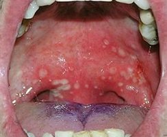 Herpangina oral lesions