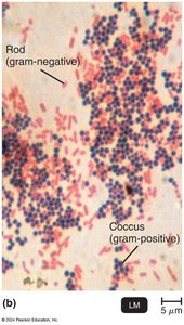 Acid-fast stain of Mycobacterium tuberculosis