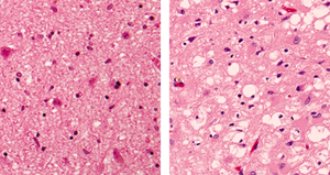 Brain tissue showing vacuole formation in prion disease