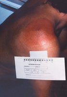 Bull's eye rash characteristic of Lyme disease