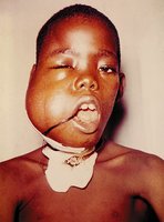 Child with Burkitt's lymphoma showing facial swelling