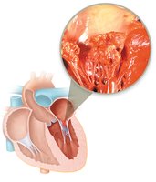 Heart with bacterial endocarditis showing vegetations on valves